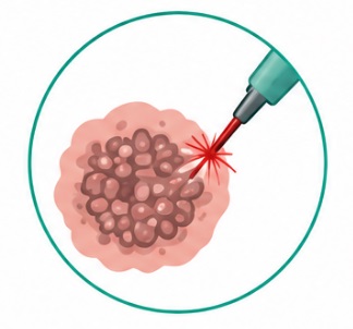 Genital warts laser and cautery treatment in Karachi