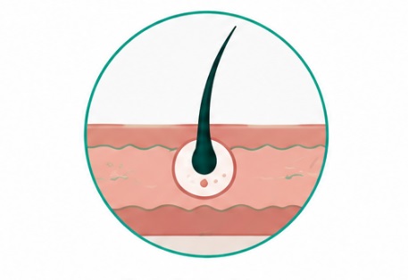 Pilonidal sinus laser treatment in Karachi
